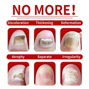 Ginger Nail Essence Fungus Treatment 30ml Nail Care No Brand