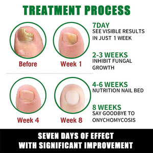 Ginger Nail Essence Fungus Treatment 30ml Nail Care No Brand