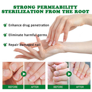 Ginger Nail Essence Fungus Treatment 30ml Nail Care No Brand 