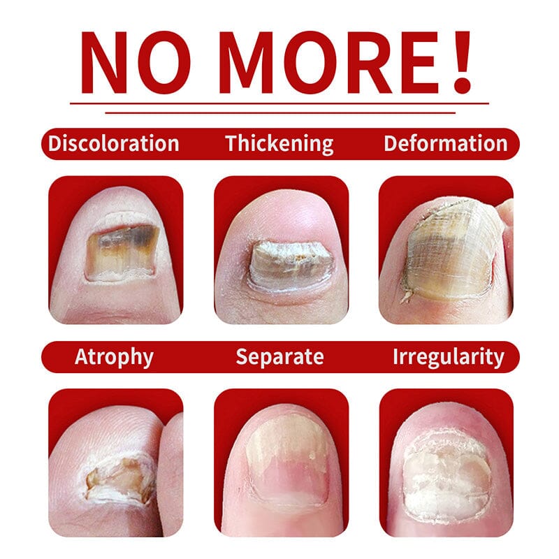 Ginger Nail Essence Fungus Treatment 30ml Nail Care No Brand 