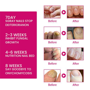 Ginger Nail Essence Repair Fungus Treatment 10ml Nail Care No Brand 