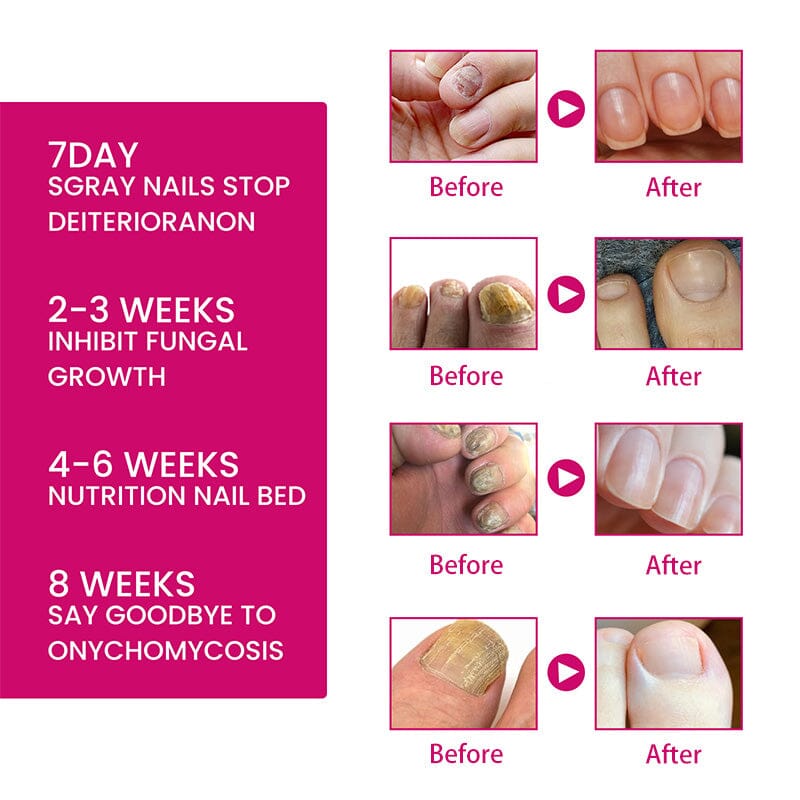 Ginger Nail Essence Repair Fungus Treatment 10ml Nail Care No Brand 